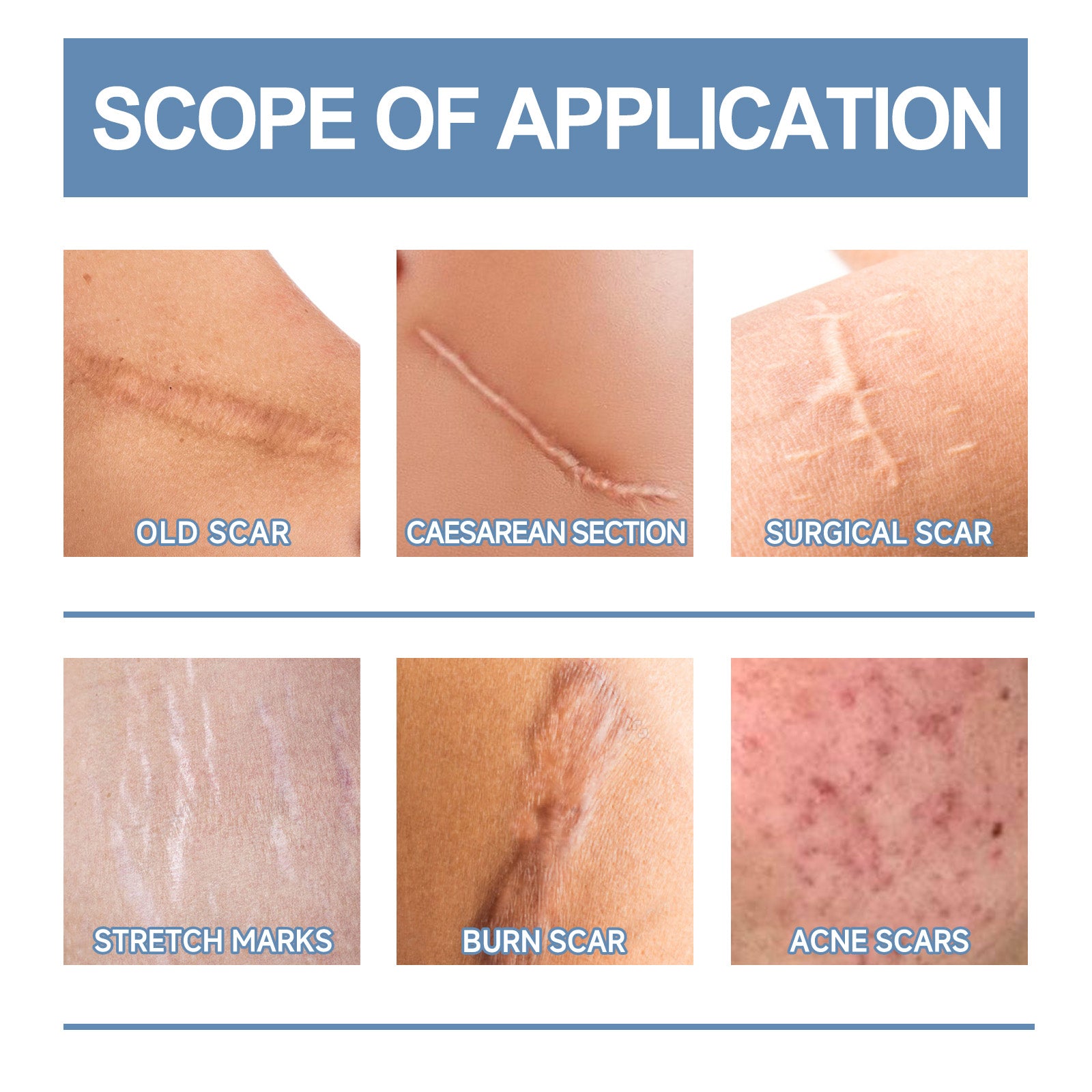 Gel réparateur éclaircissant pour cicatrices Oceaura – Hydrate et lisse la peau, répare les cicatrices chirurgicales, gel de soin post-grossesse