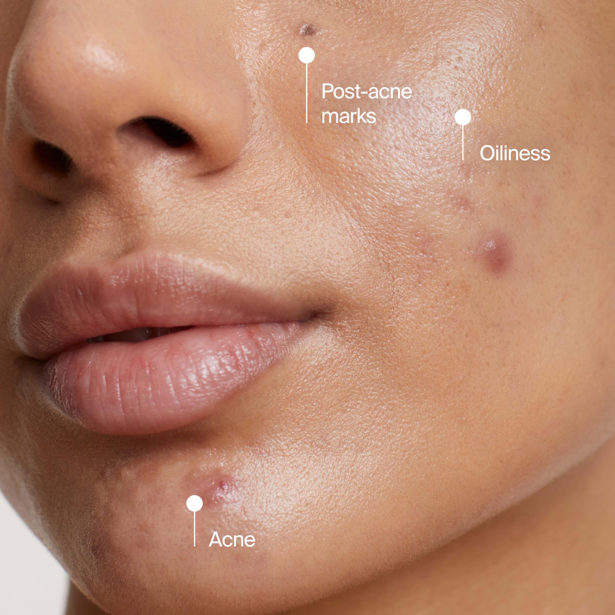 Masque Nettoyant Visage Anti-Acné Neutrogena Evenly Clear avec Peroxyde de Benzoyle à 3,5 % Traite les Éruptions Cutanées et Argile de Bentonite, Masque Purifiant à l'Argile Absorbe l'Huile pour Améliorer Visiblement l'Apparence de la Peau, 125 ml
